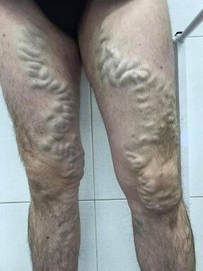 zanemarene muške proširene vene