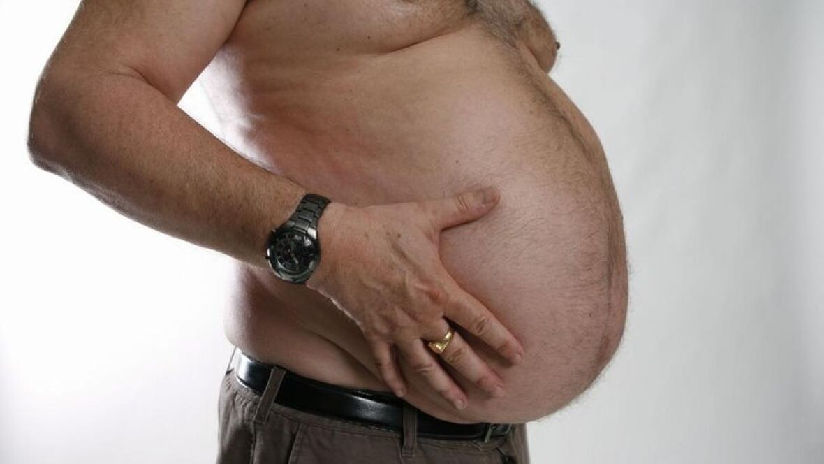 gojaznost kao uzrok razvoja proširenih vena