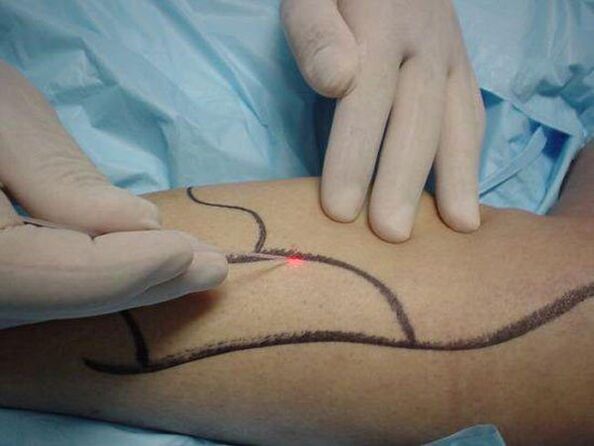 lasersko liječenje proširenih vena