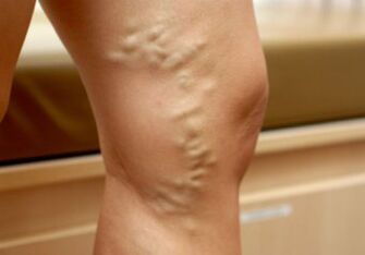Proširene vene na ženskim nogama